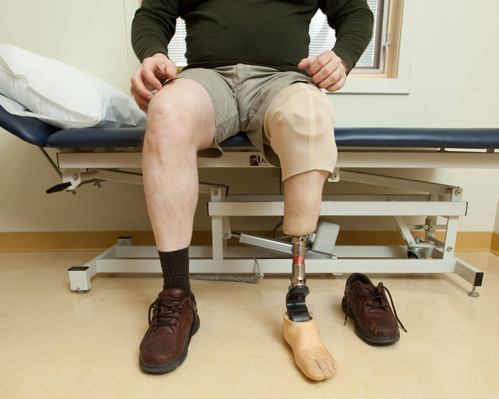 Below knee transtibial suction prosthesis